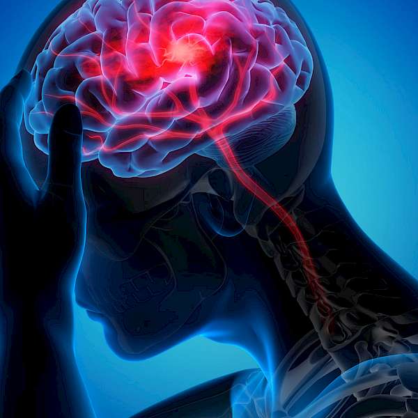 Different Types of Food are Linked to Risks of Different Types of Strokes